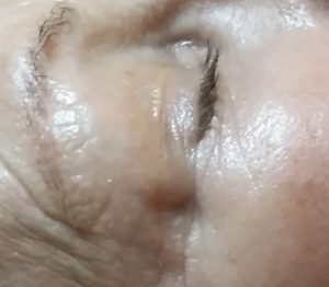 After one treatment