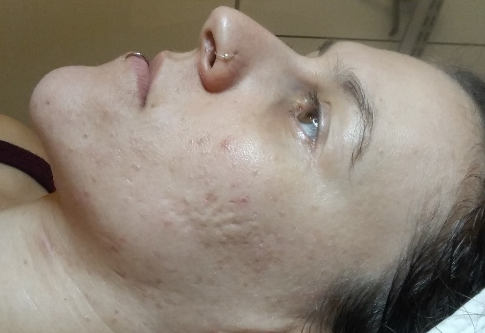 After a course of 6