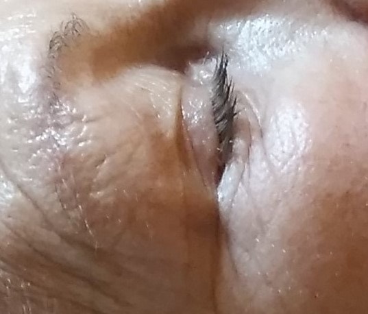 Before one treatment